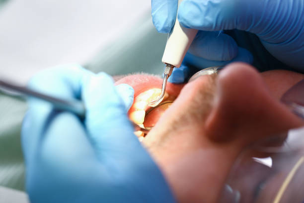 Best Emergency Tooth Extraction in La Crosse, KS